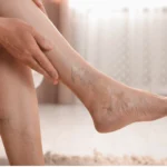 Clínica de Fleboestética Avanzada